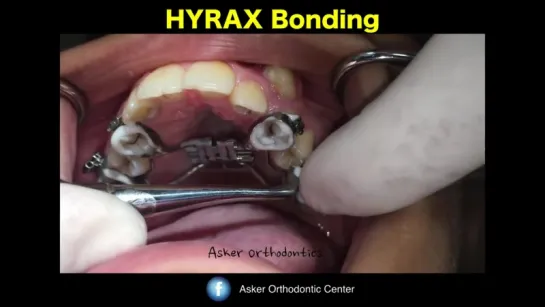 bonding HYRAX expander in orthodontics- maxilla expansion-orthodontic education and courses. Ортодонтия.