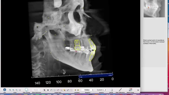 How to trace the Ceph from a CT scan