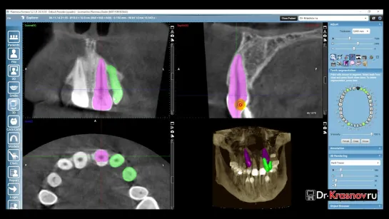 Сегментация зубов в Planmeca Romexis