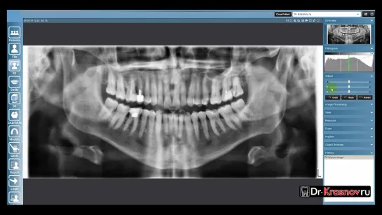 Как улучшить качество ОПТГ после съёмки используя инструменты Planmeca Romexis