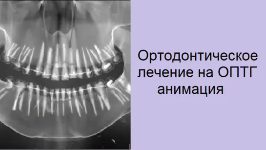 Движение зубов на ОПТГ во время ортодонтического лечения на брекетах. Стоматология.