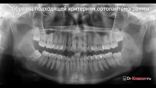 Критерии оценки качества ортопантомограммы. Образец исследования.