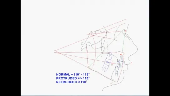 SASSOUNI PLUS PART 1 Cephalometric Analysis by Ohlendorf Appliance Lab.Ортодонтия