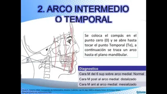 ANALISIS DE TWEED Y SASSOUNI. Ортодонтия.