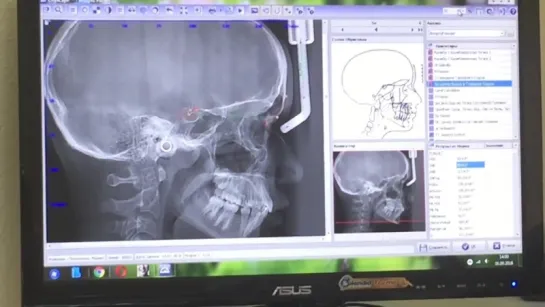 Телерентгенограмма. Установка точек в программе OnyxCeph. Ортодонтия. Гнатология. Светлана Коваль