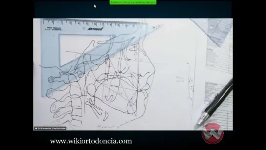 Cefalometría de  Ricketts III.Ортодонтия.