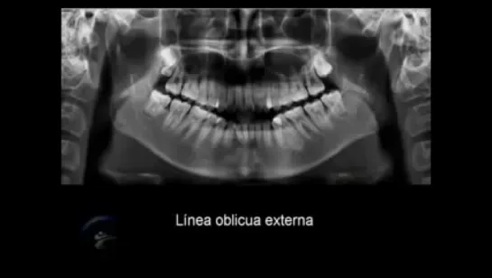 Anatomía en la radiografía panorámica II Anatomic panoramic image II