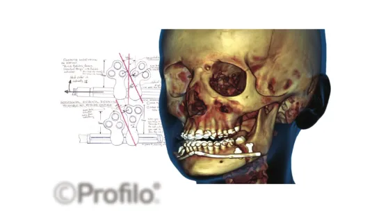 How IMDO  GenioPaully was developed. jaw surgery redesigned