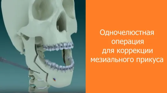 Одночелюстная операция для коррекции мезиального прикуса. Гнатическая хирургия. Стоматология