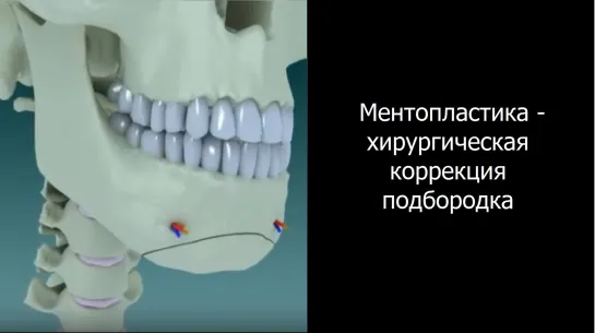 Ментопластика - хирургическая коррекция подбородка. Ортогнатическая хирургия.