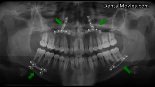 Orthodontic Surgery. Ортонатическая хирургия.