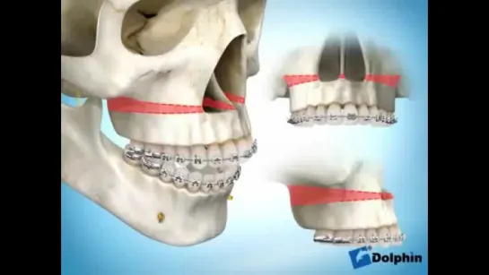 Орто хирургическое лечение открытого прикуса