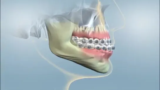 Having orthognathic surgery.Гнатическая хирургия. Ортодонтия.