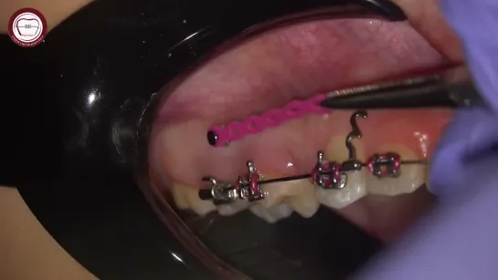 Step bye step crimpable hooks placement+En-masse retraction in Orthodontics, Asker Orthodontics