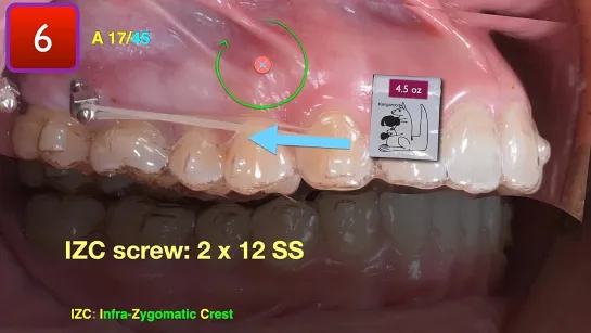 Chris Chang Ortho Class II Mechanics for Overjet Reduction Part2