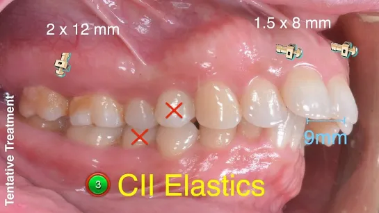 Chris Chang Ortho. CII Tx with Aligners：Mandibular Advancement in Adults Part1