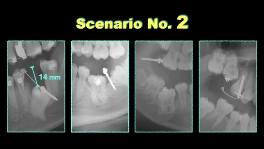 Chris Chang Ortho. OBS Solutions for Ankylosis