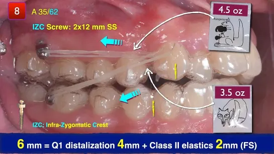 Chris Chang Ortho. Screws  Aligners