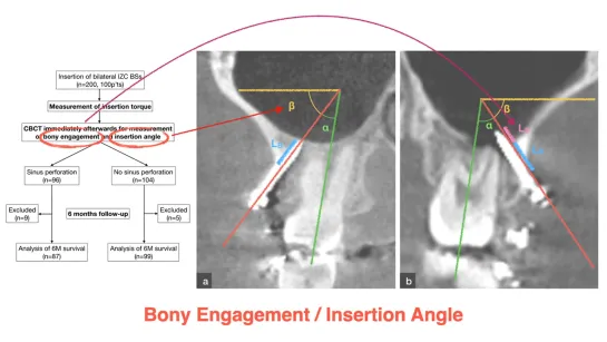 Chris Chang Ortho.  Infra-Zygomatic Crest Miniscrews