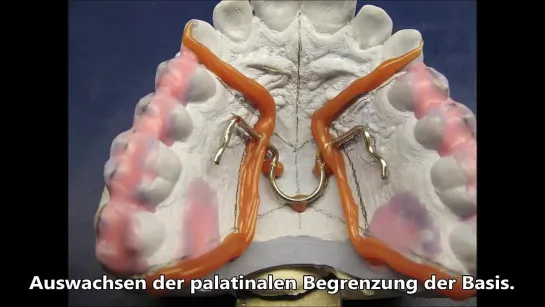 Изготовление Бионатора. Ортодонтия. Зуботехническая работа.