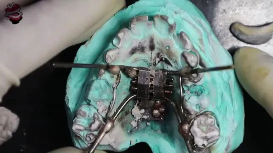 Arch Expansion with Hyrax Screw. Зуботехническая работа. Ортодонтия.