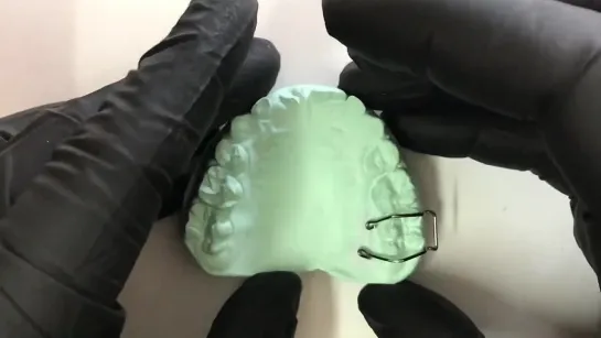 Adams Clasp on Partially Erupted Molar. Ортодонтия. Зуботехническая работа.