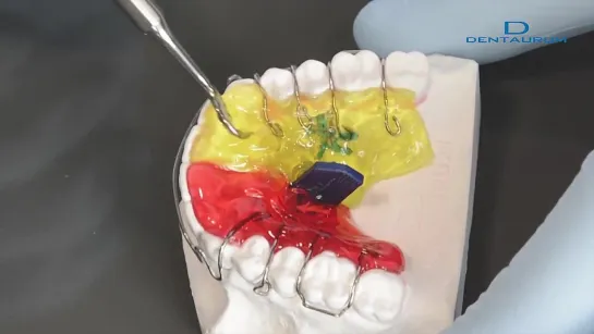 Orthocryl® LC – Зуботехническая работа.