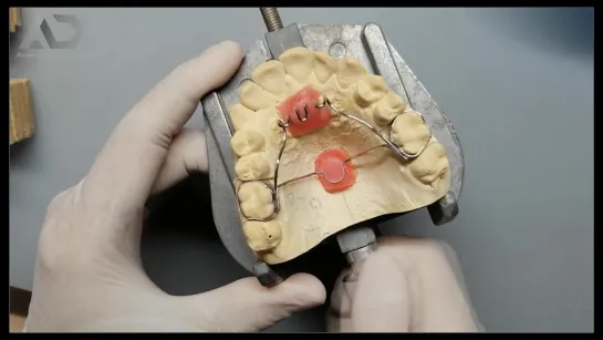 Soldando BTP + Trampa Lingual. Ортодонтия. Зуботехническая работа.