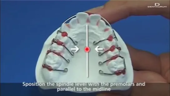 Позиционирование винта на ортодонтическом аппарате. Зуботехническая работа.Ортодонтия.
