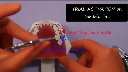 Unilateral derotation of molar with TPA.Ортодонтия. Биомеханика.