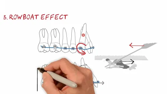 5 Orthodontic Analogies. Еssential Biomechanics.Ортодонтия.