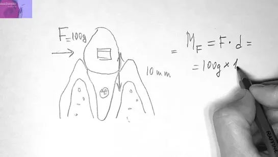 Биомеханика и ортодонтия.Tooth movement biomechanics. Orthodontic tooth movement