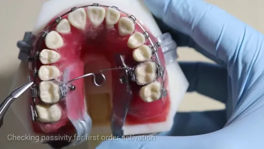 Rectangular Loop GIV Activation. Ортодонтия