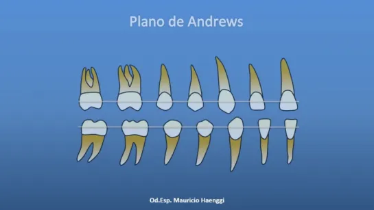 Ubicación de los Brackets. Ортодонтия.