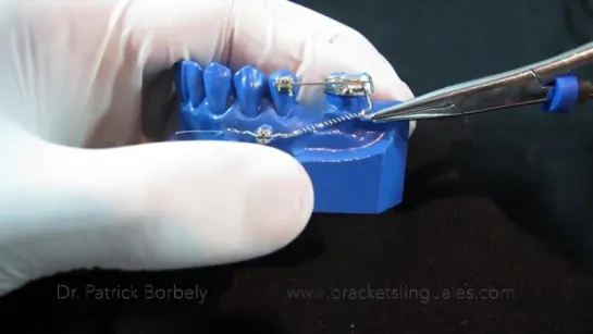 BIOMECÁNICA CON MINI IMPLANTES # 5 MESIALIZACIÓN MOLAR 1. Ортодонтия.  Миниимпланты.