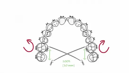 Transpalatal Arch Activations. Ортодонтия.