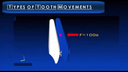 Types Of Tooth Movement - Essential Biomechanics. Ортодонтия.