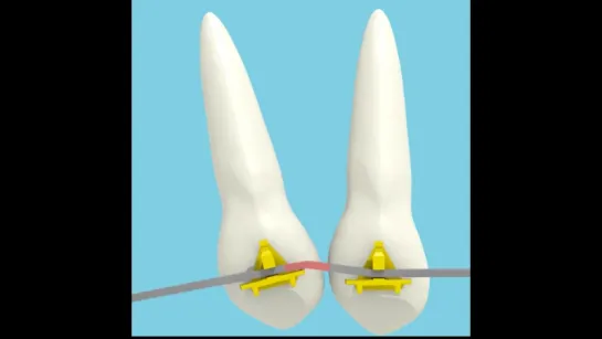 Tooth Uprighting. Ортодонтия. Брекеты. Биомеханика.