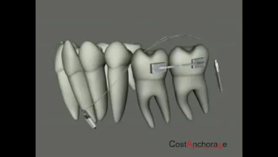 Миниимплантаты в ортодонтии.