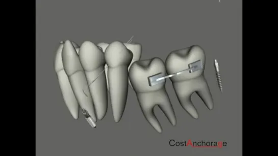 Costanchorage System. Ортодонтия.