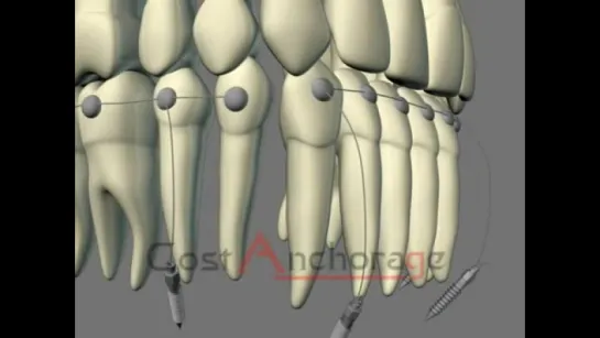 Second class molar and canine key correction. Ортодонтия.