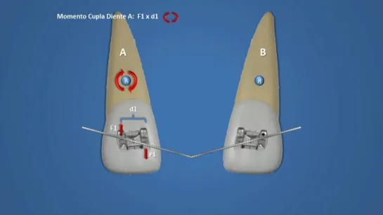 Biomecanica parte 3. Fuerzas Equilibrantes. Ортодонтия.