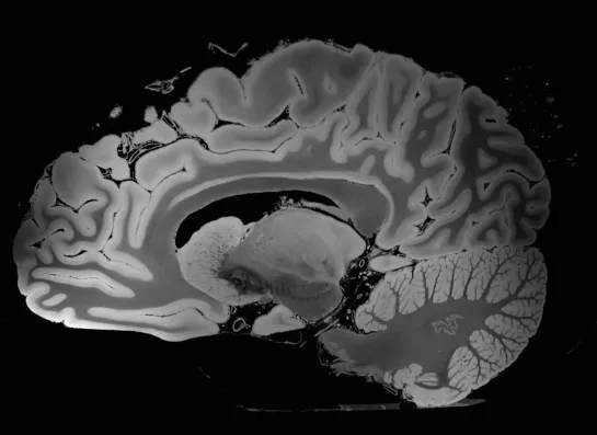 100 MICRON MRI OF THE HUMAN BRAIN - SAGITTAL. Самое подробное и точное МРТ головного мозга