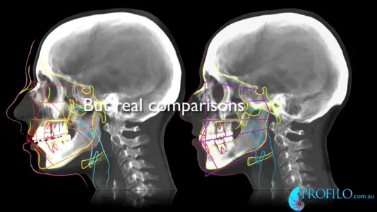 Erin has jaw surgery. Watch video-end first. Before  after jaw surgery. Correction dental overbite. Ортодонтия.