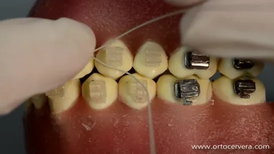 ORTOCERVERA. Ligadura Continua con Brackets  Autoligado Camaleón. Ортодонтия.