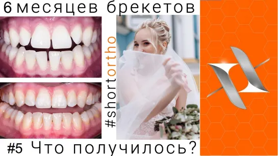 Ортодонтическое лечение на брекетах за 6 месяцев?! До и после. #shortortho