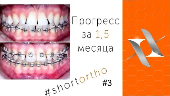 Что сделали  брекеты за 1,5 месяца #Shortortho (Выпуск №3)