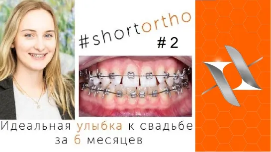 Идеальная улыбка к свадьбе за 6 месяцев. Брекеты. #Shortortho (Выпуск №2)