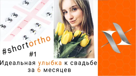 Идеальная улыбка к свадьбе за 6 месяцев. Брекеты. #Shortortho (Пилотный выпуск)