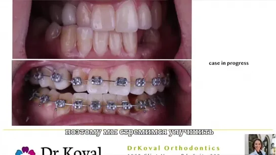 MARPE and MSE treatment DrKoval Orthodontics Boca Raton. Перевод.